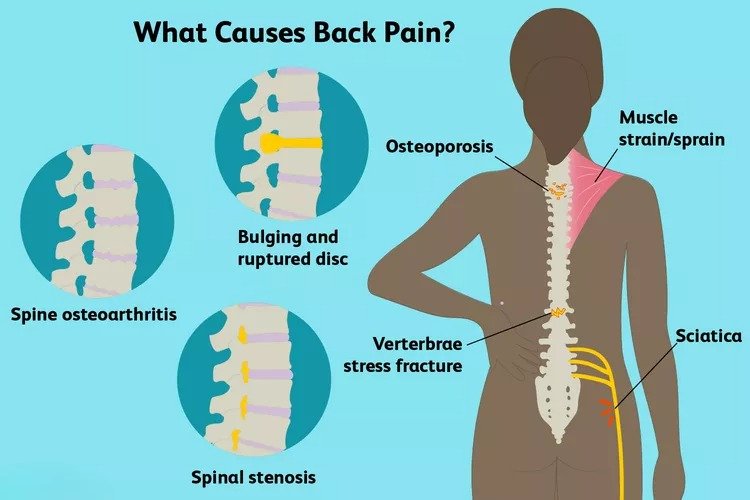 Back pain causes